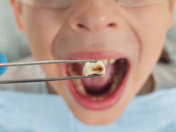 Best Emergency Wisdom Teeth Removal in Stanley, NC