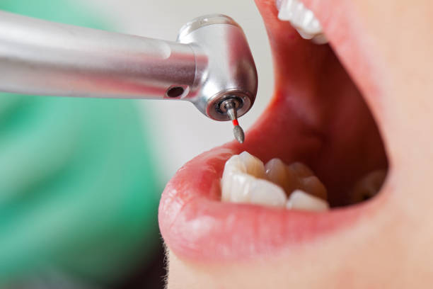 Best Emergency Tooth Extraction in Stanley, NC